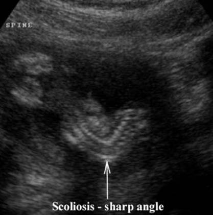 Fetal Ultrasound Congenital Scoliosis